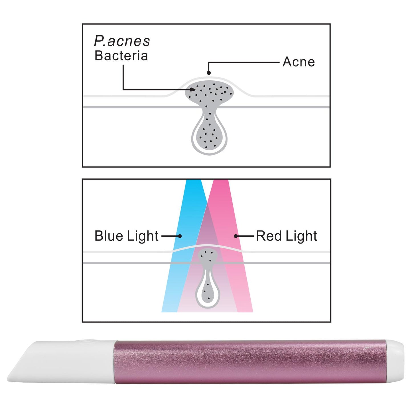 Acne Light Therapy Device, LED Light Therapy Pen, Blue Light Therapy for Acne, Portable Acne Treatment